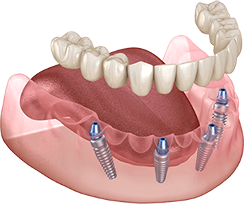 時間や費用などの負担を抑えられるオールオン4 イメージ01