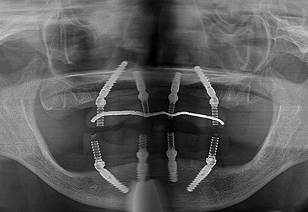 時間や費用などの負担を抑えられるオールオン4 イメージ02