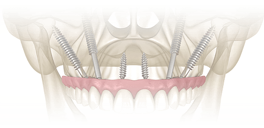 骨が極端に薄いケースでも可能なザイゴマインプラント イメージ01