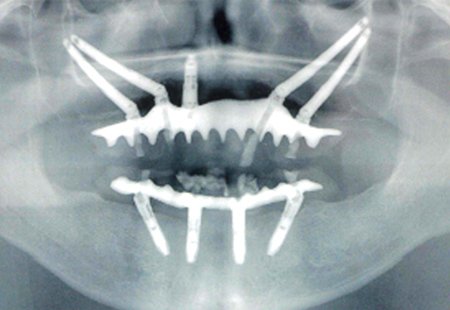 骨が極端に薄いケースでも可能なザイゴマインプラント イメージ02