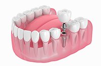 通常のインプラント イメージ