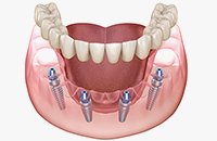 オールオン4 イメージ