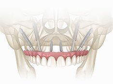 ザイゴマインプラント イメージ