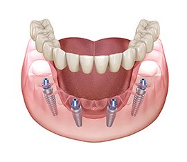 治療の流れ イメージ7